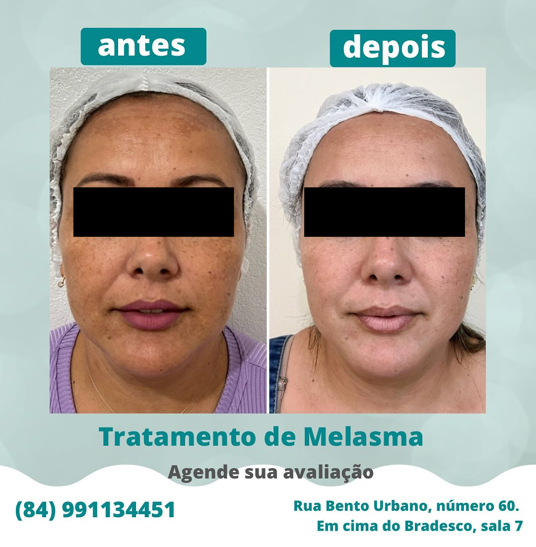Tratamento para Melasma